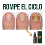 Micofin - Elimina el Hongo de la Uña en 7 Días 100% Natural